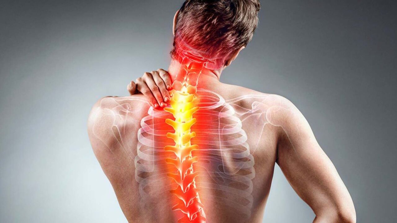 sintomi di osteocondrosi spinale